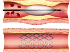 Specialty Alloys for Medical Industry